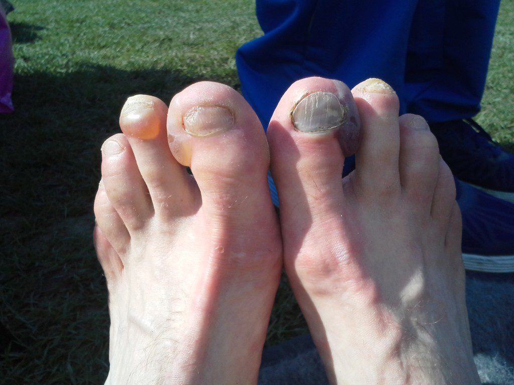 Tällaista jälkeä saa 24 h aikaan varpaille